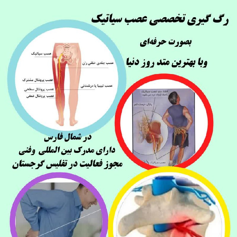 رگ‌گیری عصب سیاتیک بصورت کاملا حرفه ای